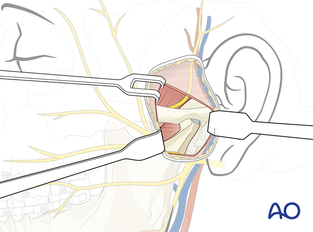 Preauricular approach