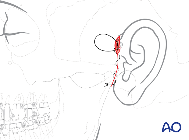 Wound closure – preauricular approach Preauricular approach.