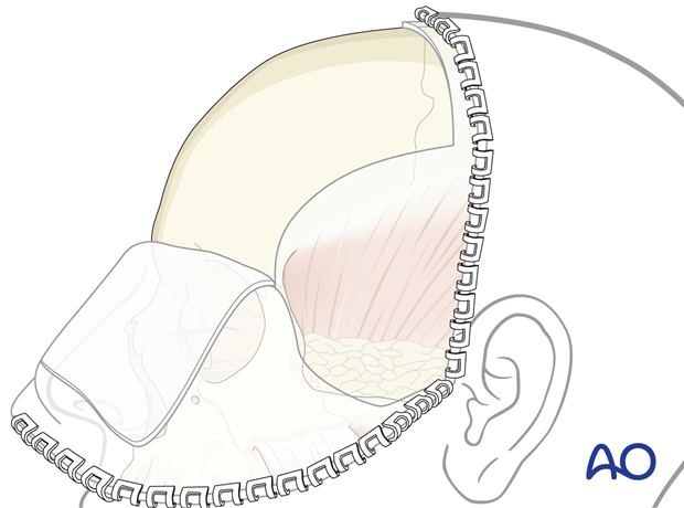 Coronal approach.