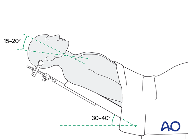 Patient position – coronal approach.