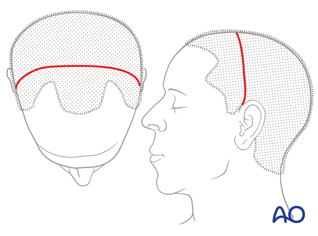 Location of the scalp incision line – coronal approach.