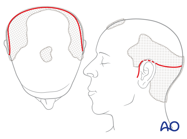 Locating the incision line and preparation – coronal approach.