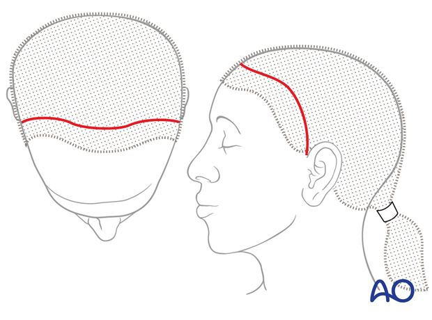 Anteriorly over the vertex placed incision – coronal approach.