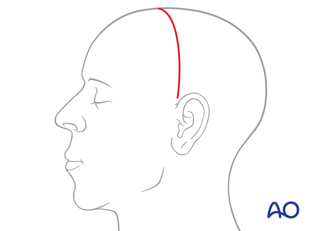 Inferior extent of the incision line – coronal approach.