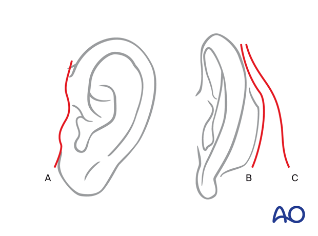 Examples of incision extensions – coronal approach.