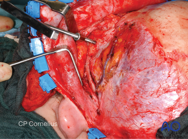 Clinical photograph showing the incision behind the ear along the postauricular fold and the resulting exposure of the zygomatic arch and the zygoma – coronal approach.