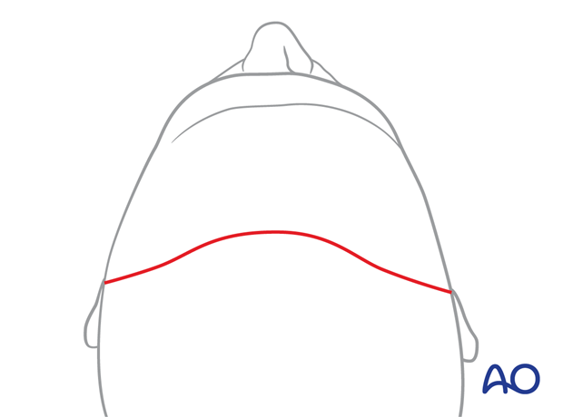 Bow-like incision – coronal approach.