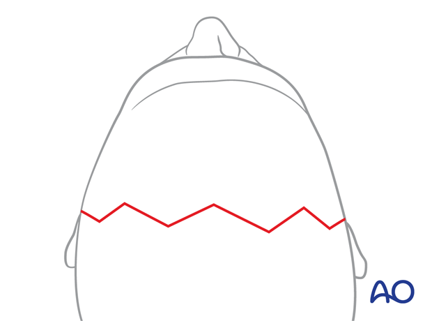 Zigzag incision design – coronal approach.