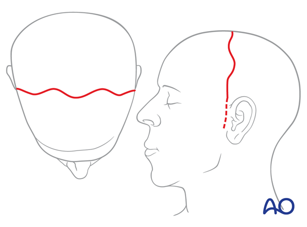 Wave pattern incision design – coronal approach.