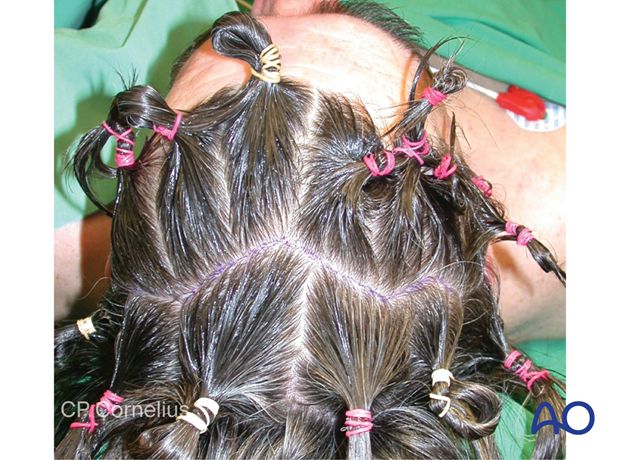 Clinical photograph showing hair preparation without shaving – coronal approach.