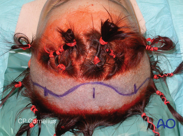 Clinical photograph showing hair preparation and shaving – coronal approach.