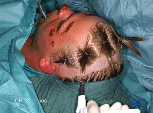 Clinical photograph showing stapling the to the scalp – coronal approach.