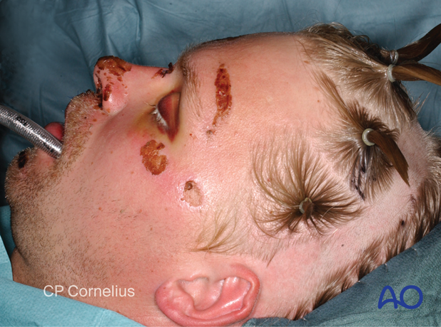 Clinical photograph showing drapes covers the hair of the posterior scalp – coronal approach.