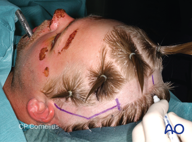 Clinical photograph showing the delineating of the sagittal midline – coronal approach.