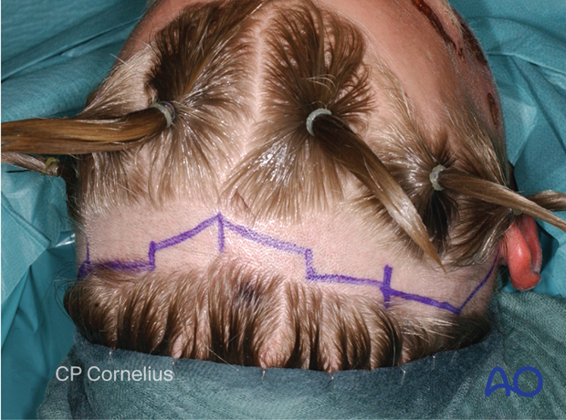 Clinical photograph showing the complete drawing of the extended coronal scalp incision in a stepwise design – coronal approach.