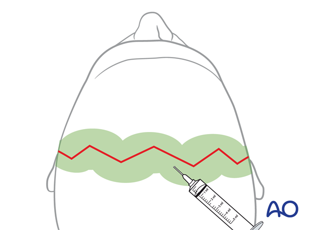 Infiltration of a vasoconstrictor into the subgaleal plane – coronal approach.