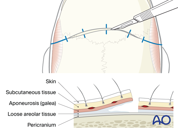 Incision – coronal approach.