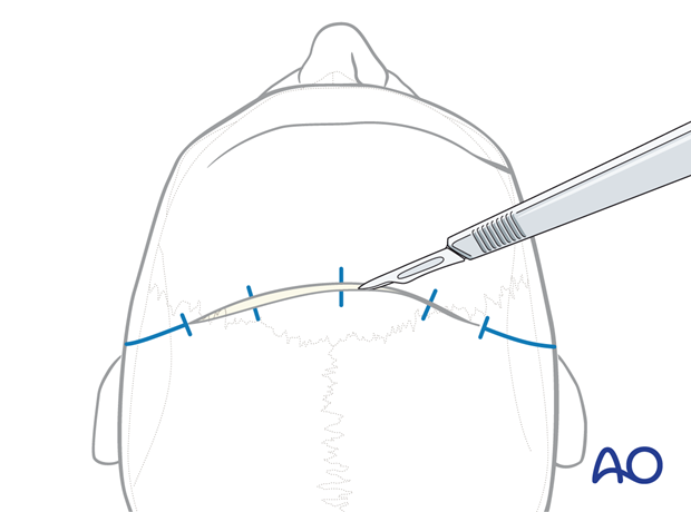 The incision is made with a number 10 blade – coronal approach.