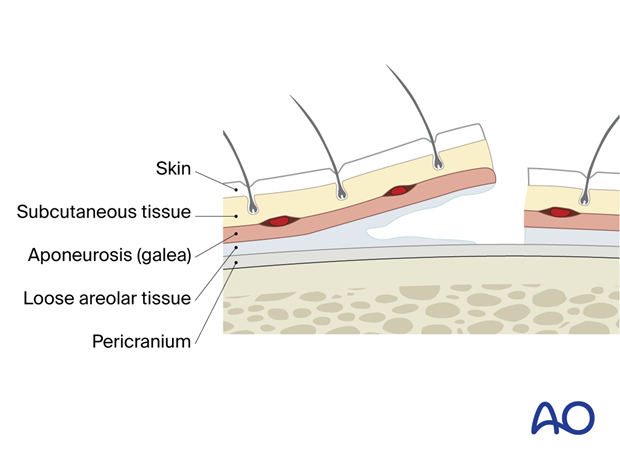 The incision superficial to the pericranium in the superficial loose areolar plane – coronal approach.