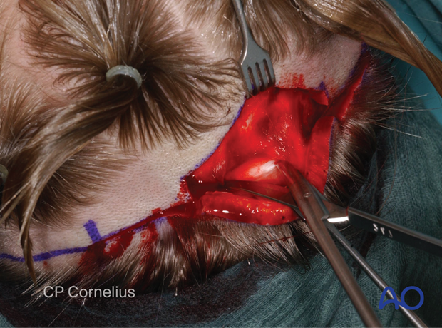 Clinical photograph showing identification and beginning dissection in the loose areolar tissue of the subgaleal plane – coronal approach.