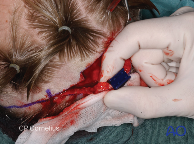 Clinical photograph showing the gauze sponges applied along the wound edges prior to clip application – coronal approach.