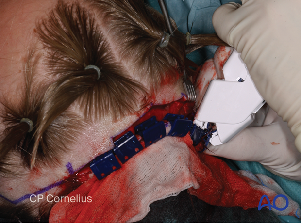 Clinical photograph showing the use of a disposable clip delivery device – coronal approach.