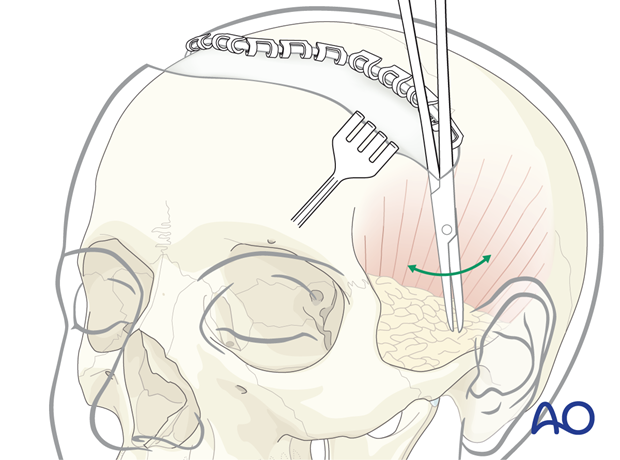 Temporal extension of the skin incision line – coronal approach.