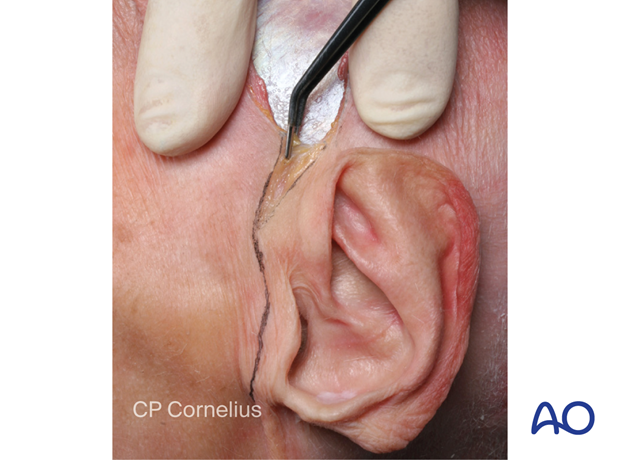 Photograph showing the preauricular extension of the incision – coronal approach.