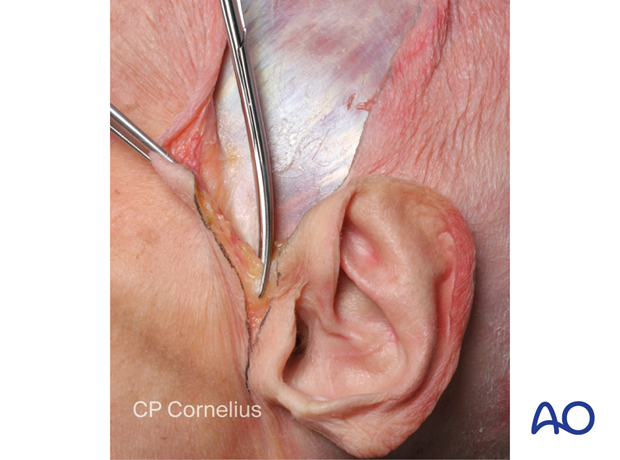 Photograph showing the transected preauricular muscles.