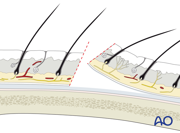 Beveled incision – coronal approach.