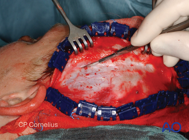 Clinical photograph showing exposing the temporalis fascia gently with traction and countertraction – coronal approach.