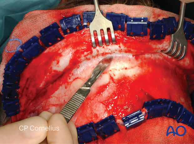 Clinical photograph showing cutting the loose areolar connective tissue overlying the pericranium by sharp dissection – coronal approach.