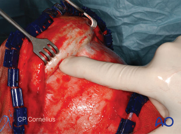 Clinical photograph showing the undermined flap with finger dissection – coronal approach.