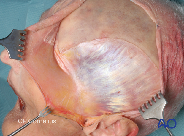 Photograph showing the silvery white temporalis fascia – coronal approach.