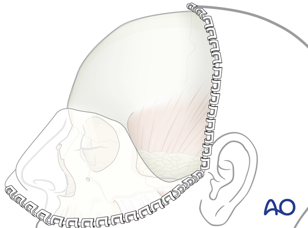 Inside out turned coronal flap – coronal approach.