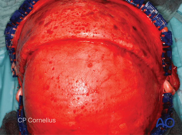 Clinical photograph showing the continued dissection of the coronal flap to the level of the supraorbital rims.