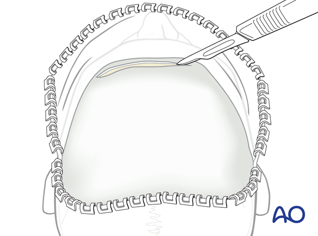 Cross-forehead horizontal incision – coronal approach.