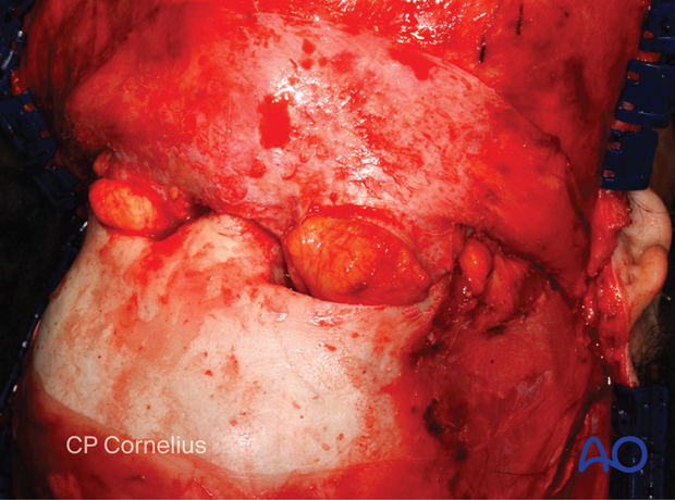 Elevation of the coronal flap.