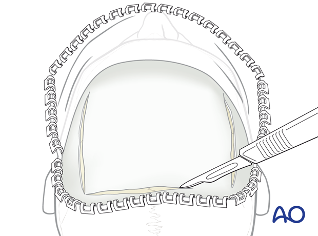 Bilaterally incisions along the superior temporal lines from the anterior to the posterior extent of the exposed surface – coronal approach.