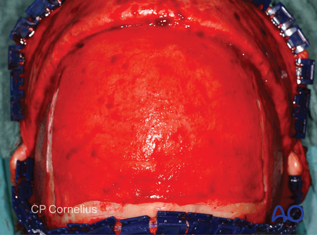 Clinical photograph showing Bilaterally incisions along the superior temporal lines from the anterior to the posterior extent of the exposed surface – coronal approach.