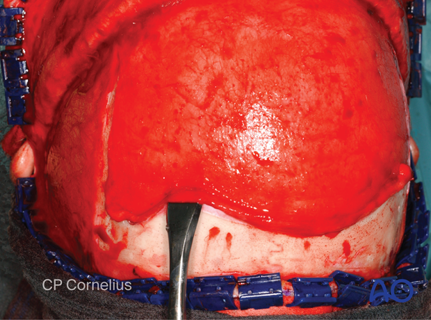 Clinical photograph showing sharp square periosteal elevators elevating the pericranial flap – coronal approach.