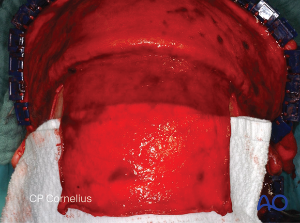 Clinical photograph showing using a dry gauze pad to elevate the periosteal flap – coronal approach.