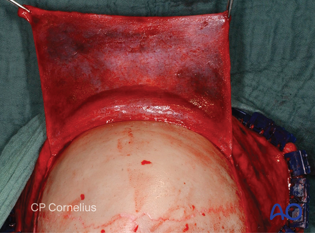 Clinical photograph showing the development of pericranial flap – coronal approach.