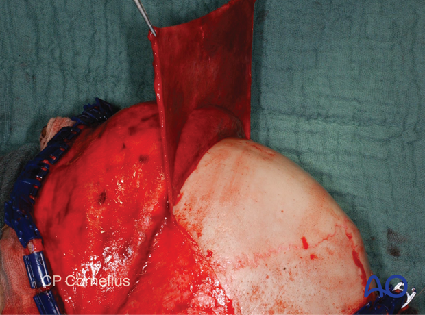 Clinical photograph showing the development of pericranial flap – coronal approach.