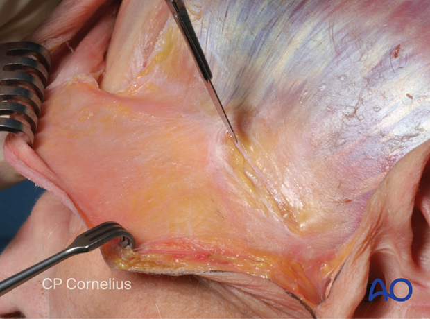 Photograph showing lateral dissection of the coronal flap is continued from the subgaleal plane of the scalp to the temporal region – coronal approach.