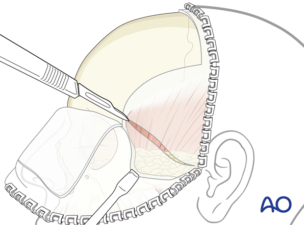 Oblique incision of the superficial layer of temporalis fascia – coronal approach.