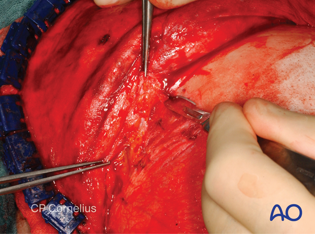 Incision of the superficial temporal fascia for exposure of the zygomatic arch