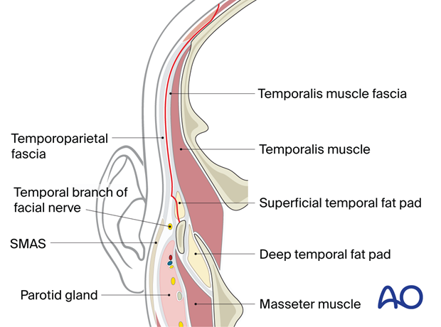 Incision of the superficial temporal fascia for exposure of the zygomatic arch