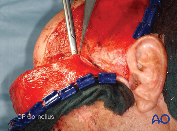 Incision of the superficial temporal fascia for exposure of the zygomatic arch