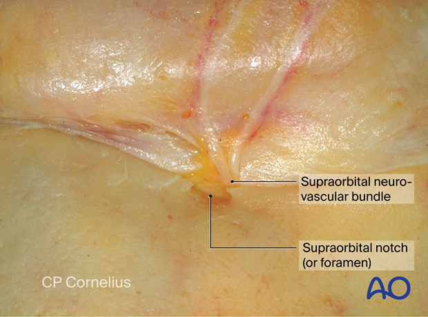 Photograph showing the supraorbital neurovascular bundle and supraorbital notch (or foramen) – coronal approach.